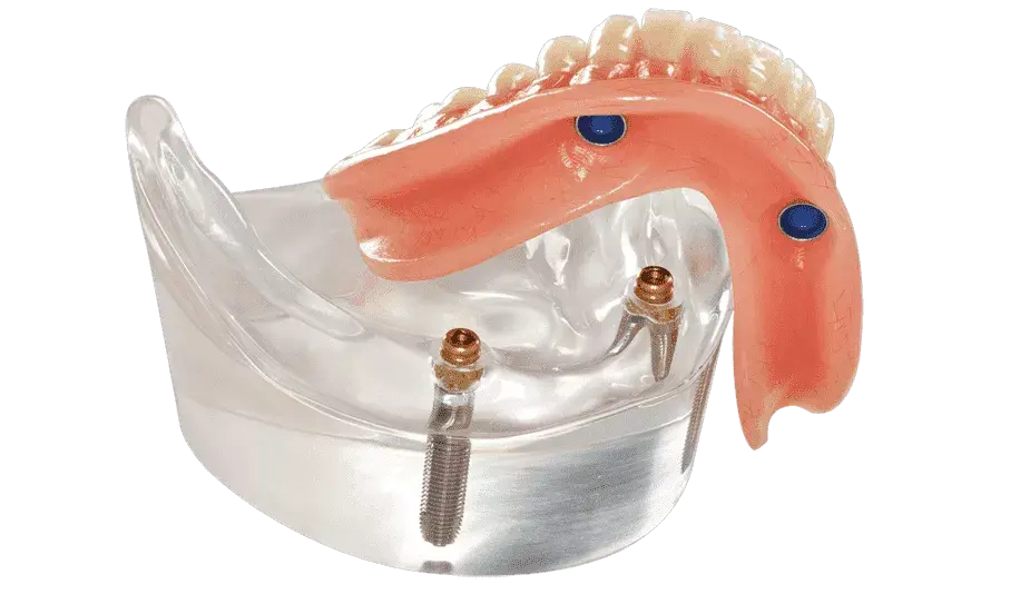 2-locators-overdenture 2-locators-overdenture